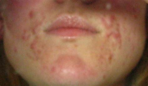 Hormonal Acne: New Science on How to Beat It