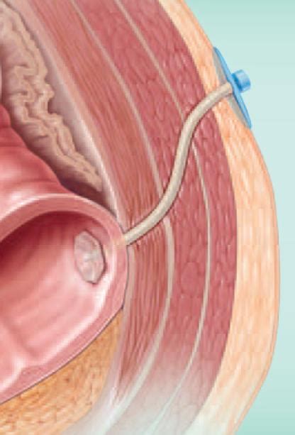 Enterocutaneous Fistulas