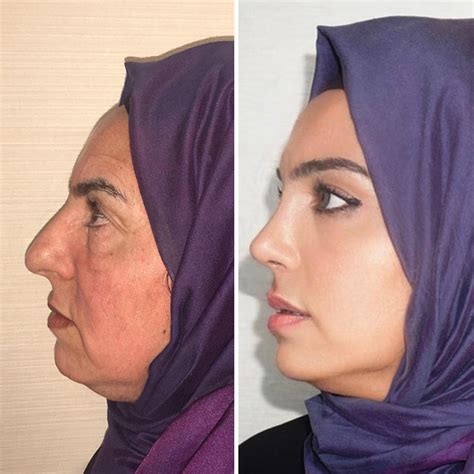 68-Year-Old Woman Sheds 20 Years In Unbelievable Plastic Surgery Procedure