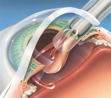 Lens Cataract After Surgery at Tamara Brodie blog