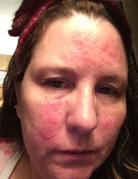 Lupus butterfly rash ? Or is this rosacea? | Lupus rash, Skin disorders, Lupus butterfly rash