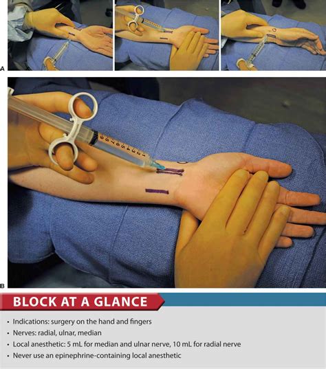 Wrist Block | Anesthesia Key