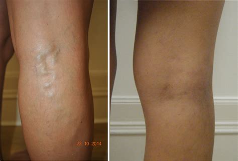 varicose vein surgery - DrBeckmann