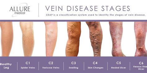 Varicose Veins | Allure Blog