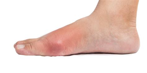 Diseases of the Foot | Benenati Foot and Ankle Care Centers