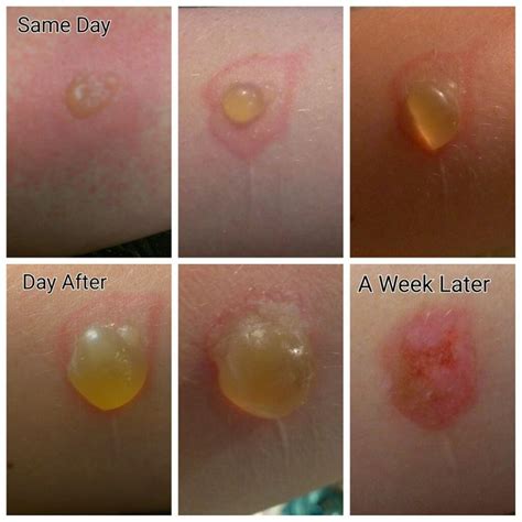 2nd Degree Burn Healing Stages