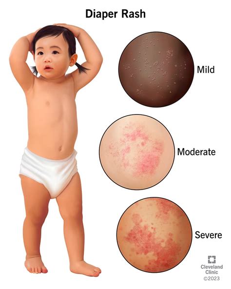 Diaper Rash: Symptoms, Causes & Treatment