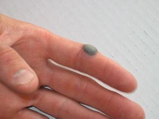 Blood Blister | Causes, Symptoms & Treatment | Study.com