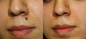 Mole Removal Prices, Costs | Skin Surgery Laser Clinic