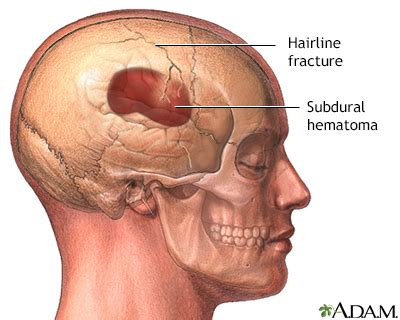 Parietal Bone Fracture