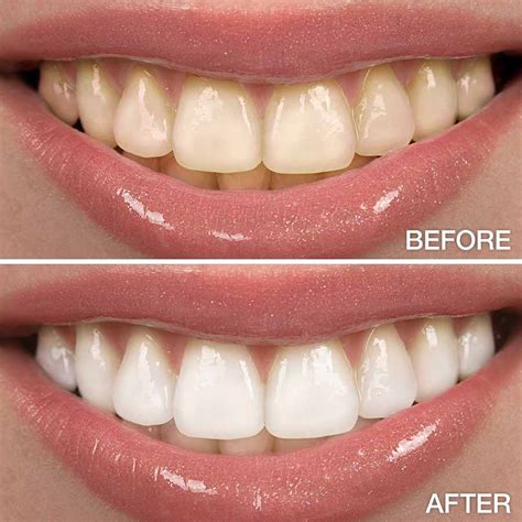 Teeth Whitening Best To Use at George Greer blog