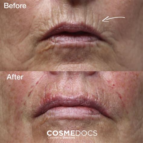 Dermal Fillers For Lip Lines Before And After | Sitelip.org