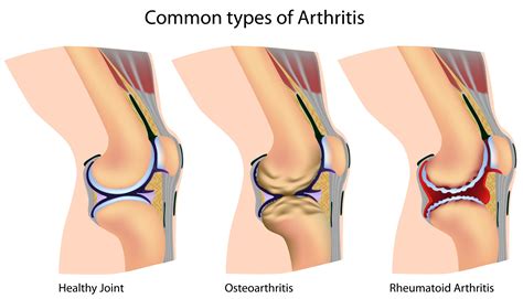 Types of arthritis that affects the knees - kneesafe.com