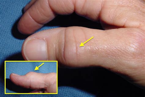 OSTEOARTHRITIS FINGER/THUMB (MP, PIP, DIP & IP) | Hand Surgery Source