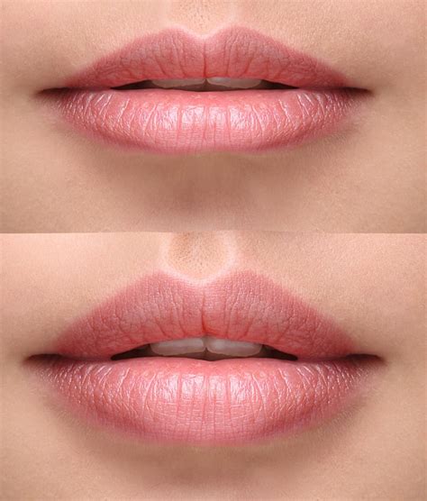 Lip Fillers - City Aesthetics Clinic Newcastle