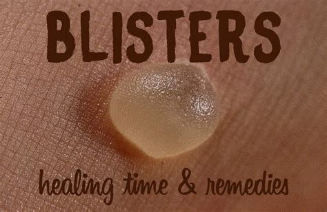 Blister Healing Time: How Long Does it Take for a Blister to Heal ...