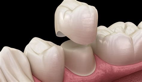 6 Common Dental Crown Problems & How To Avoid Them