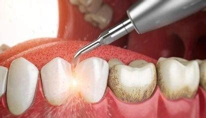 Best Dental Plaque Removal | Affordable Plaque Removal Cost