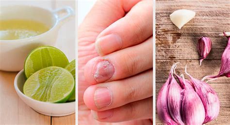 4 Home Remedies for Fungal Nail Infection Treatment | Best Herbal Health