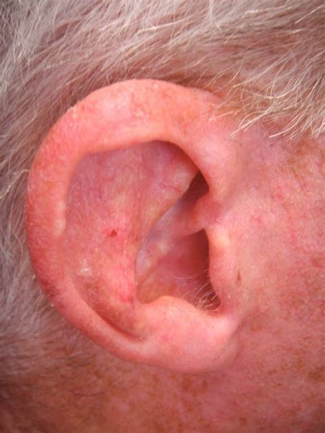Melanoma Ear