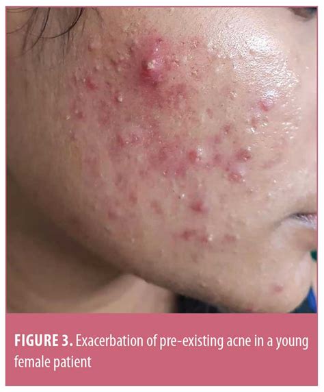 Facial Mask-related Acne and Acneiform Eruption During the Coronavirus Disease 2019 Pandemic: A ...