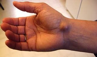 Ganglion Cyst | Wikipedia: The exact cause of the formation … | Flickr