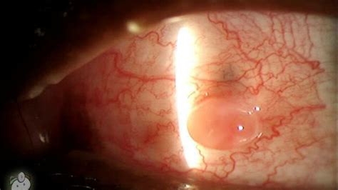 Pyogenic Granuloma on Eye Video by Tim Root - Meduweb