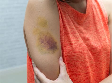 Bruise Itch Causes, Risk Factors, and Treatment