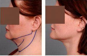 Smart Lipo Chin Before And After » Liposuction: Info, Prices, Photos, Reviews, Q&A