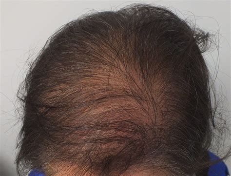 Hair Transplant For Women | Doç.Dr. Ekrem Civas - Ankara