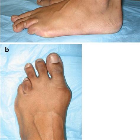 AP radiograph of the left foot demonstrating brachymetatarsia of the ...