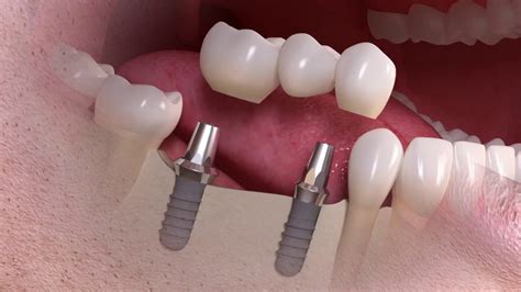 Multiple tooth replacement with Bridge - YouTube