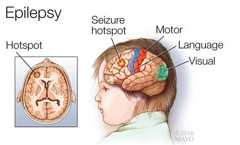 medical illustration of a brain with epilepsy; a seizure hotspot; and the motor, language and ...