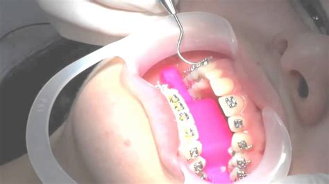 How To Put Braces ON (2015) - YouTube