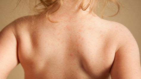 Do You Have a Rash from Hay Fever? Symptoms and Treatments | Rash treatment, Dermatitis ...