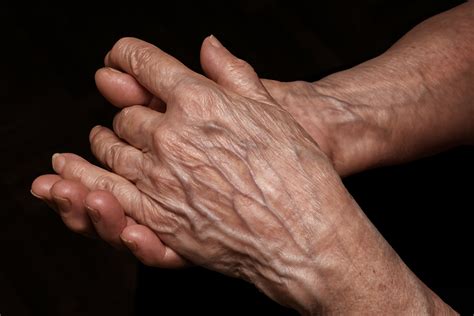 Wrinkly Hands — Pacific Coast Dermatology & Wellness Center