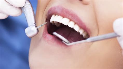 Advantages and Disadvantages of Getting Removable Veneers for Ideal Smile