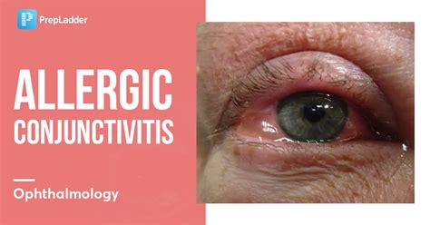 Allergic Conjunctivitis (Treatment, causes)