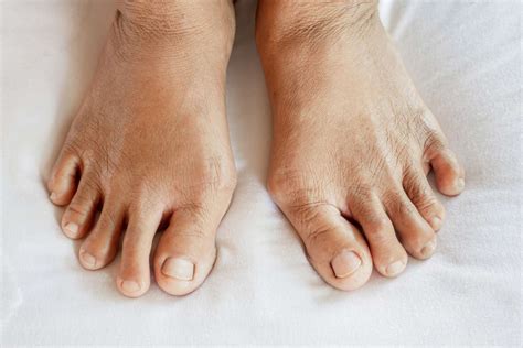 Early Signs of Arthritis in Feet