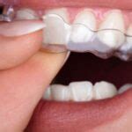 Pros and Cons of Zirconia Dental Implants – NewsVP