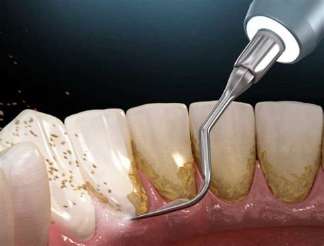 Remove Dental Plaque to Achieve your Best Smile & Improved Oral Health