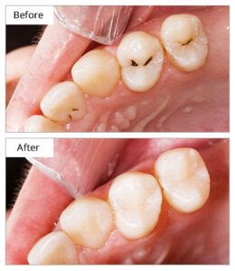 Tooth Fillings Brooklyn, NY | Dental Porcelain Fillings