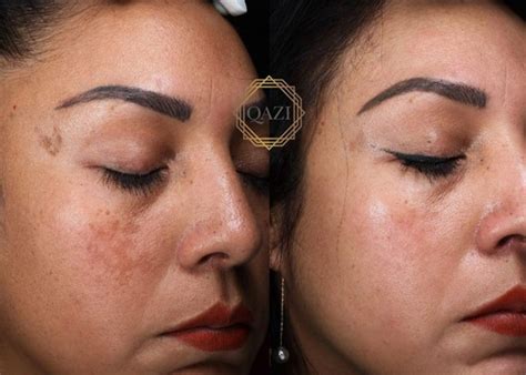 When to Stop Using Hydroquinone