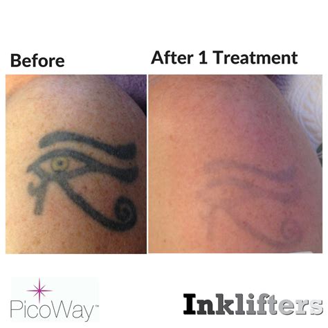 Laser Tattoo Removal Pictures After 1 Treatment - Captions Update Trendy