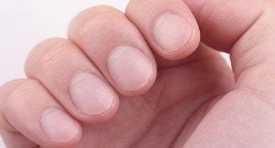 How to Treat an Ingrown Fingernail