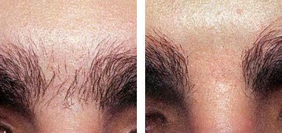 Laser Hair Removal · Laser Advantage