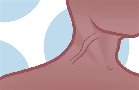 jugular vein distention symptoms Archives - Delaware Vein Center