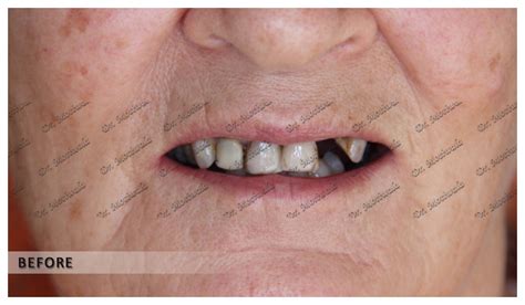 Full Mouth Dental Implants Before and After | Dental Clinic