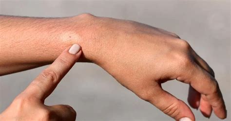 Bug Bites And Stings: Pictures, Causes, And Symptoms - TrendRadars