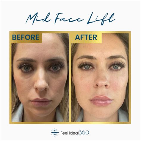 Mid Face Lift Before and After Southlake Texas - Feel Ideal 360 Med Spa ...